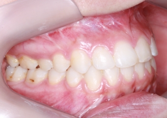 Oclusão após a cirurgia  - Clínica Cliniface