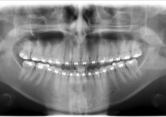 Rx panorâmico inicial - Clínica Cliniface