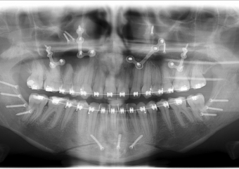 Rx panorâmico apos a cirurgia  - Clínica Cliniface