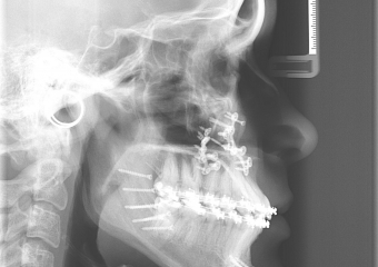 Telerradiografia após a cirurgia - Clínica Cliniface