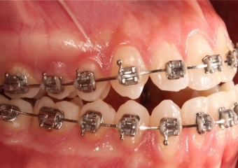 Mordida inicial  - Clínica Cliniface