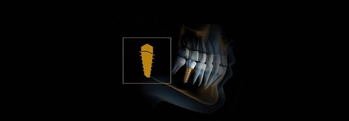 Excelência na Implantodontia