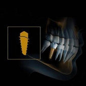 Excelência na Implantodontia